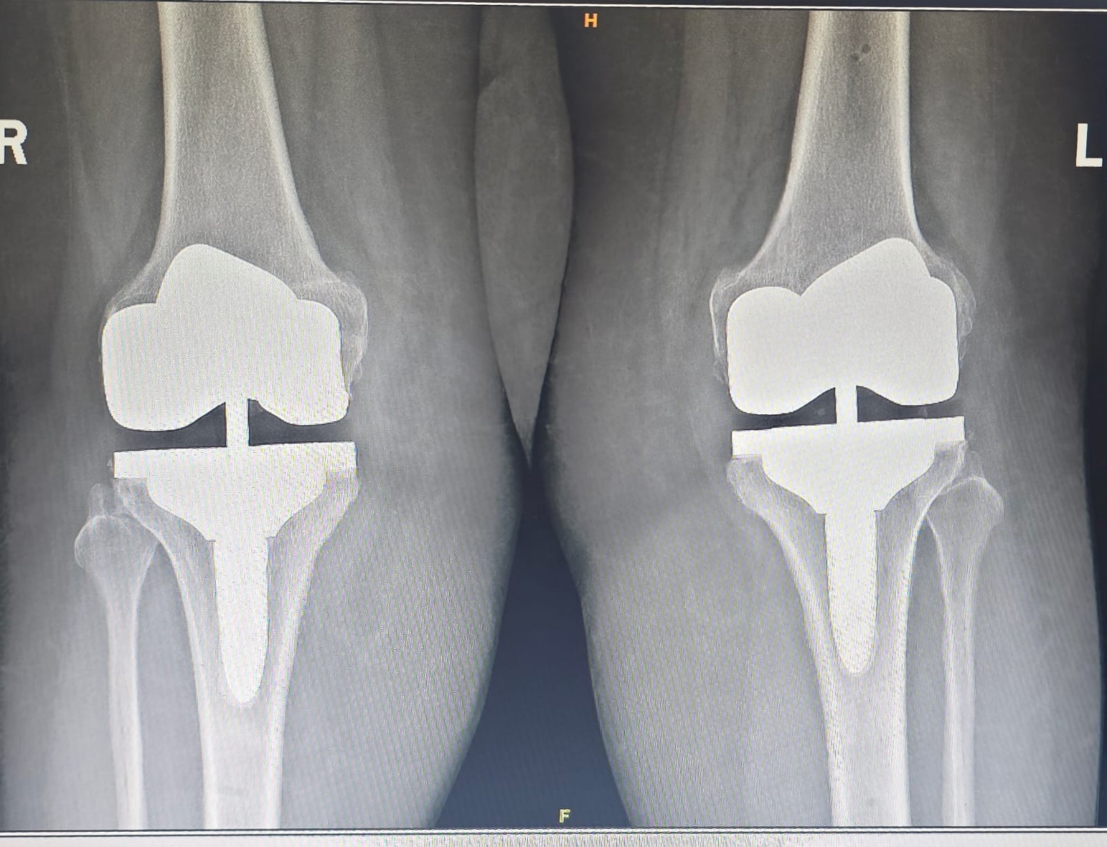 After bilateral knee replacement X-ray